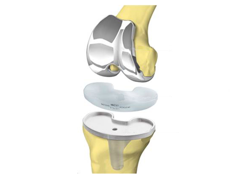 Knee Joint Prostheses